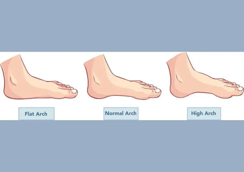 Flat feet or high arches Both can overload your plantar fascia.