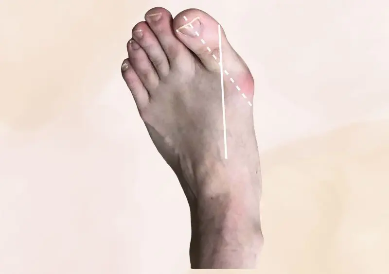 Foot structure plays a major role in plantar fasciitis risk