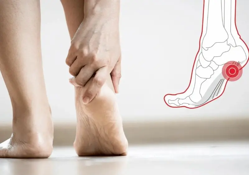 Plantar fasciitis is inflammation of the tissue supporting the arch