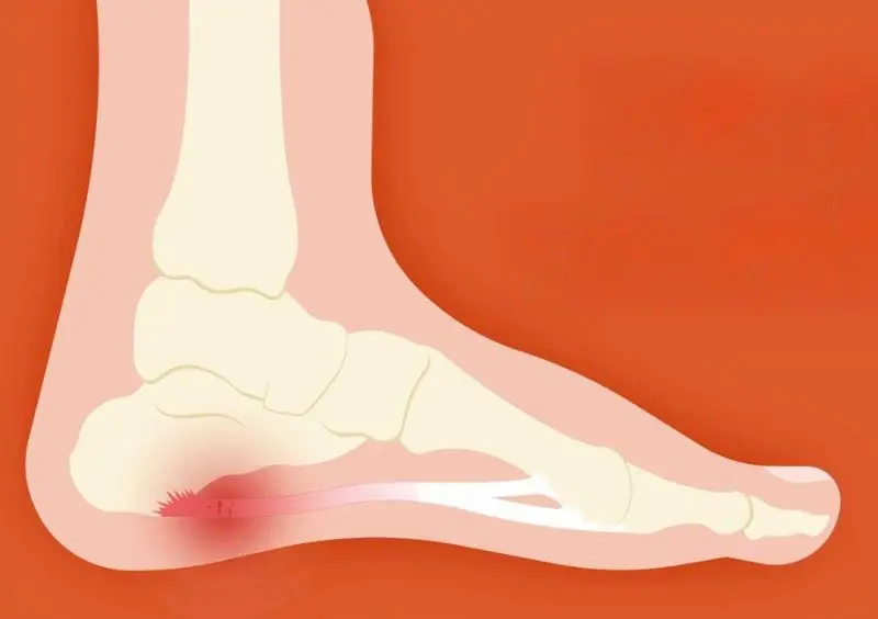 Plantar fasciitis is inflammation of the tissue under the foot