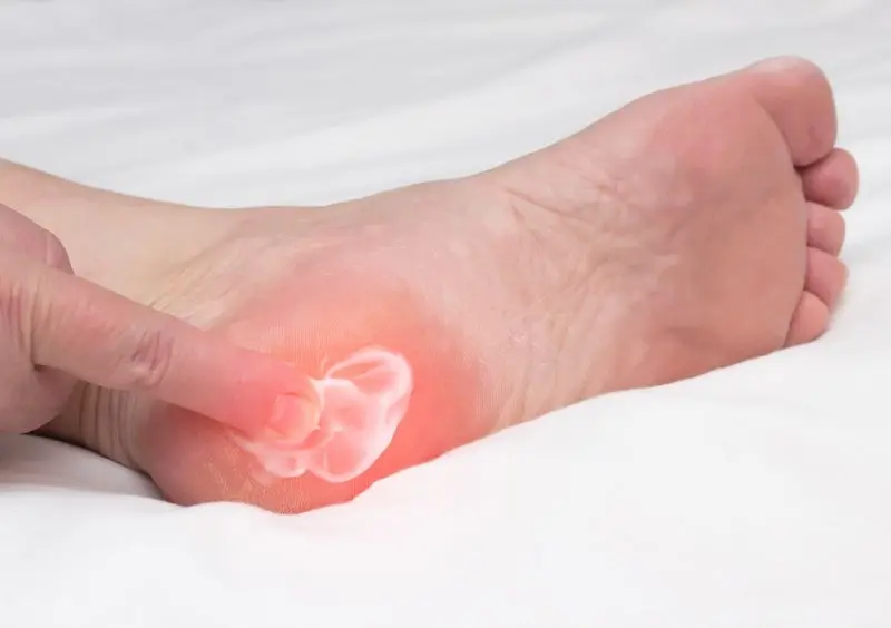 Plantar fasciitis pain often starts at the bottom inside heel